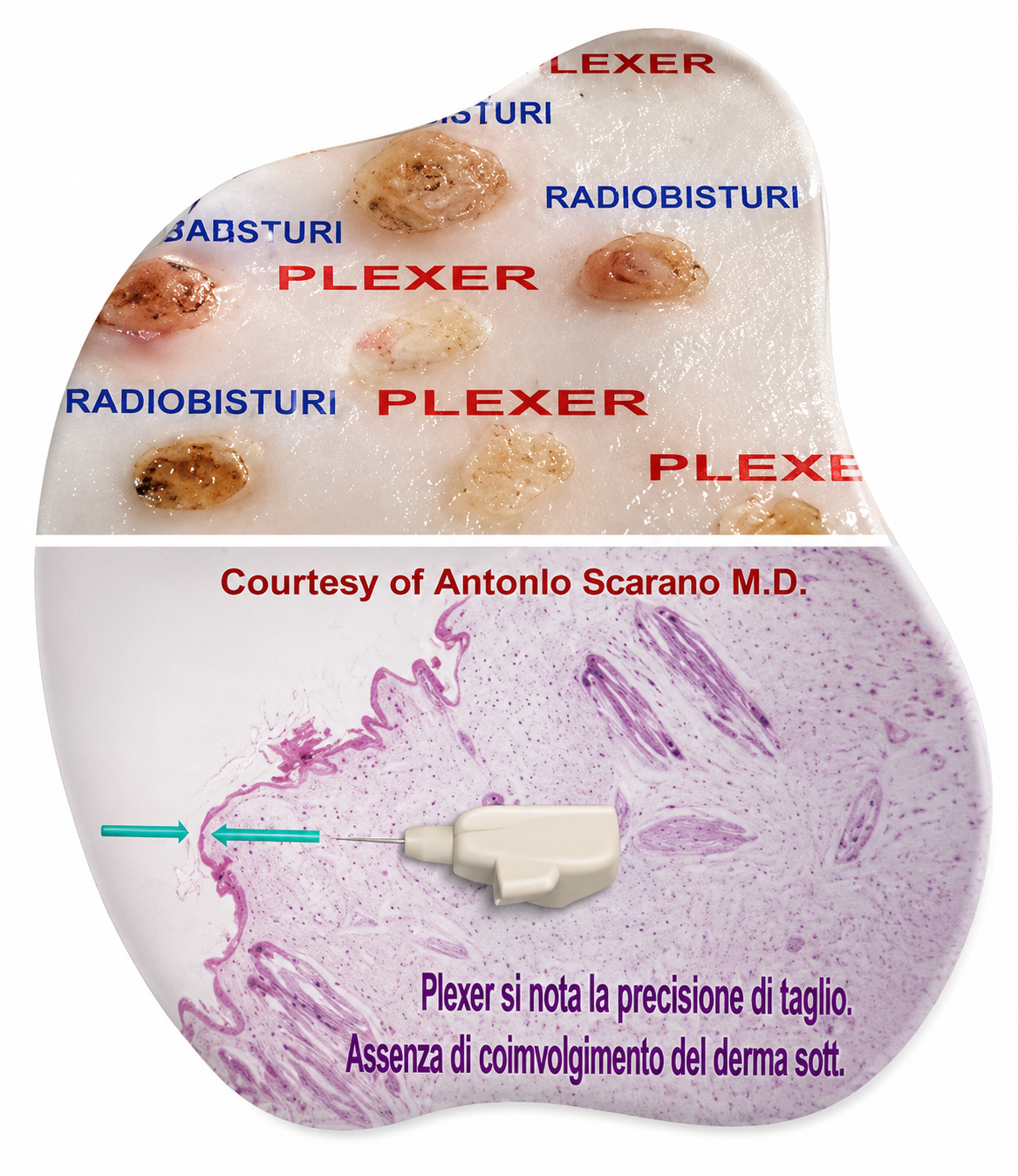 PLEXR Plus plasma technology comparison showing precise skin lesion removal with minimal impact on surrounding tissue.